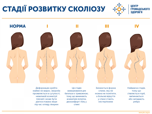 Сколиоз у детей и взрослых: как избежать заболевания