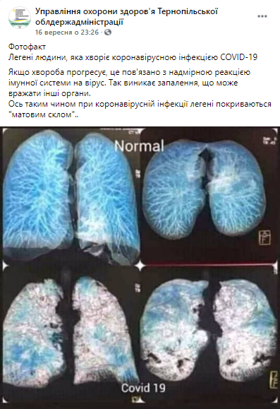 Украинские врачи показали разные стадии развития коронавируса