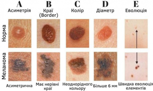 Ученые объяснили, как родинка превращается в меланому
