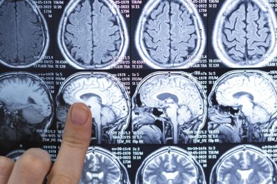 FDA одобрило первый препарат от распространенных форм опухоли мозга